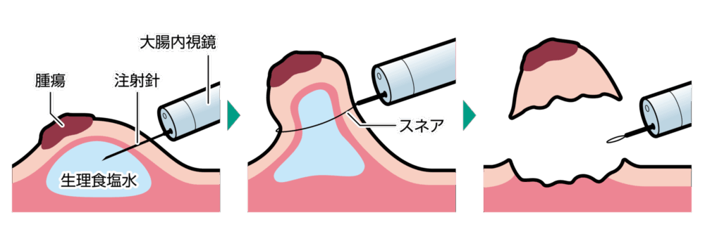 内視鏡的粘膜切除術
