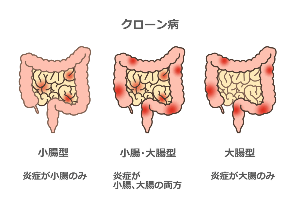 クローン病について