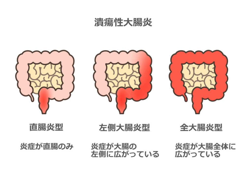 潰瘍性大腸炎について