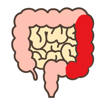虚血性大腸炎